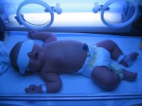 چرا باید زردی نوزاد را به موقع درمان کنیم؟
