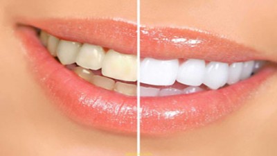 دلایل، راههای پیشگیری و درمان تغییر رنگ دندان