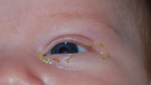 گاهی ترشحات اضافی در چشم نوزادان