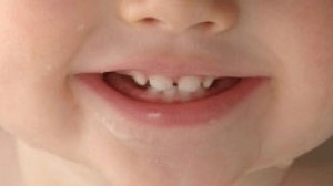 والدین پیشگیری از پوسیدگی دندان های کودکان را جدی بگیرند